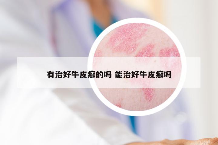 有治好牛皮癣的吗 能治好牛皮癣吗