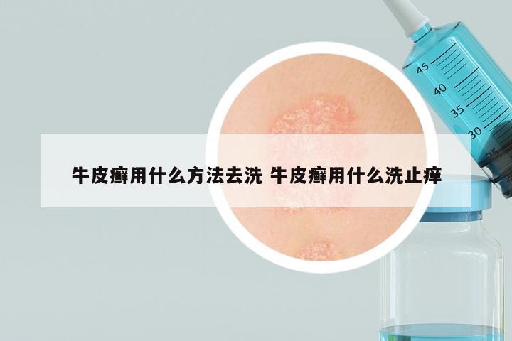 牛皮癣用什么方法去洗 牛皮癣用什么洗止痒