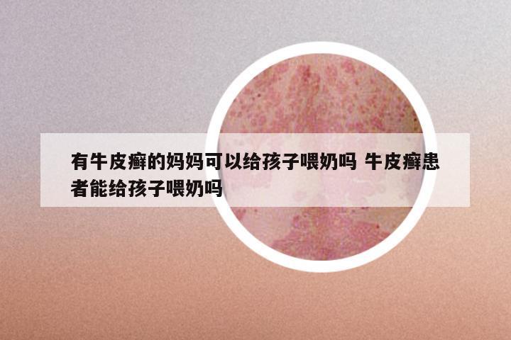有牛皮癣的妈妈可以给孩子喂奶吗 牛皮癣患者能给孩子喂奶吗
