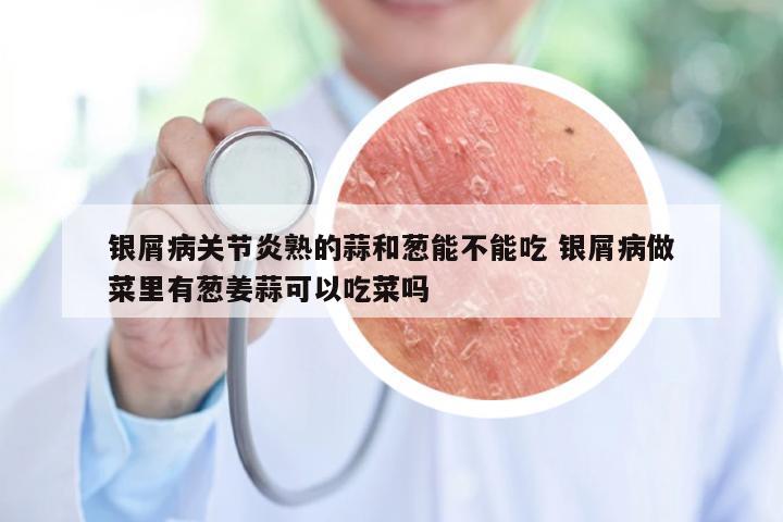 银屑病关节炎熟的蒜和葱能不能吃 银屑病做菜里有葱姜蒜可以吃菜吗