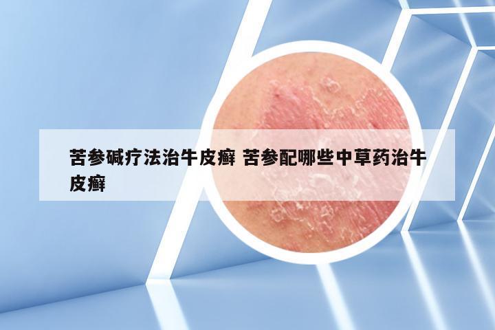 苦参碱疗法治牛皮癣 苦参配哪些中草药治牛皮癣