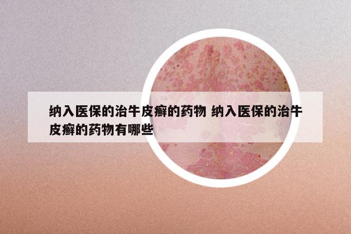 纳入医保的治牛皮癣的药物 纳入医保的治牛皮癣的药物有哪些