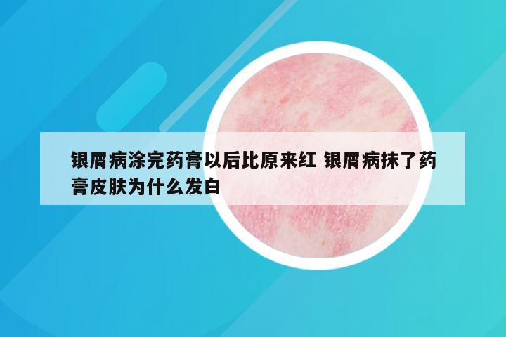银屑病涂完药膏以后比原来红 银屑病抹了药膏皮肤为什么发白