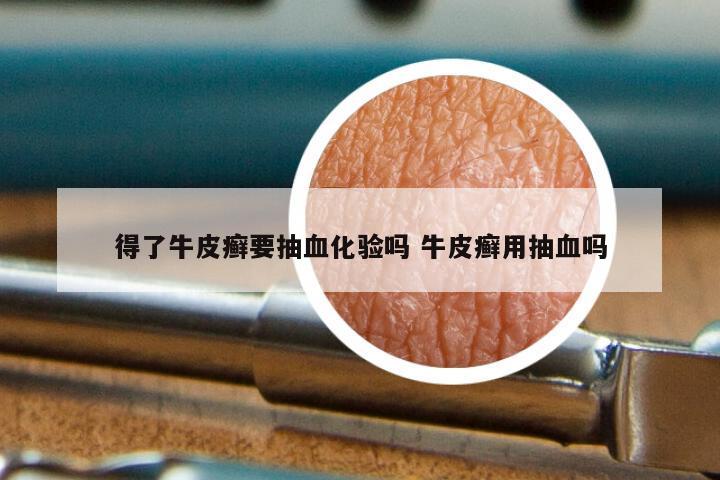得了牛皮癣要抽血化验吗 牛皮癣用抽血吗