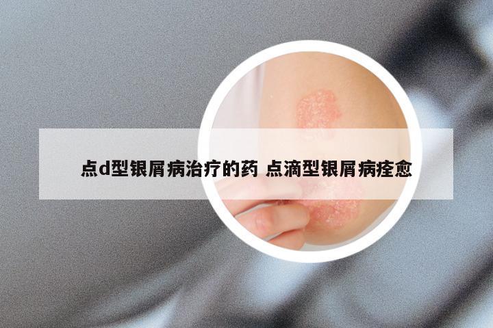 点d型银屑病治疗的药 点滴型银屑病痊愈