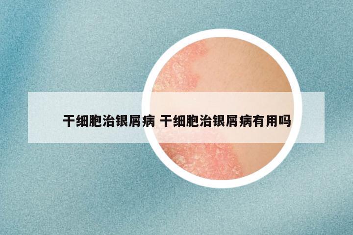 干细胞治银屑病 干细胞治银屑病有用吗