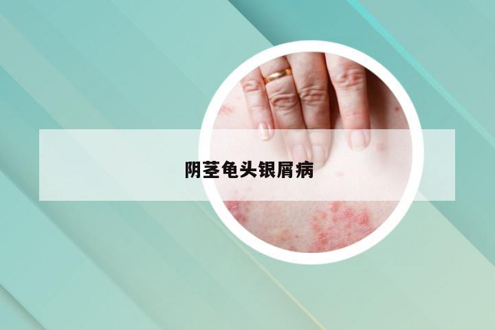 阴茎龟头银屑病