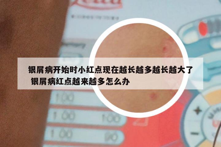 银屑病开始时小红点现在越长越多越长越大了 银屑病红点越来越多怎么办