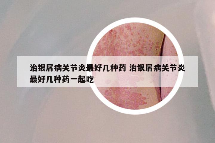 治银屑病关节炎最好几种药 治银屑病关节炎最好几种药一起吃