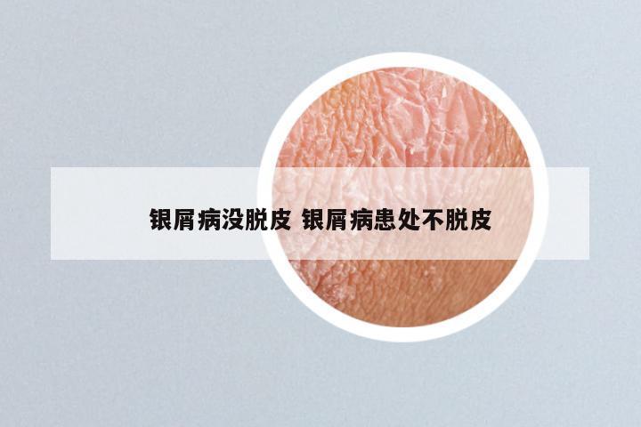 银屑病没脱皮 银屑病患处不脱皮