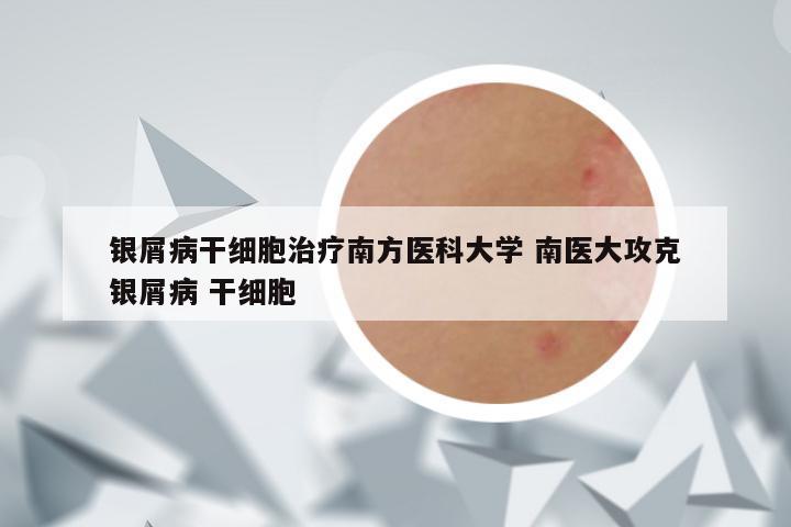 银屑病干细胞治疗南方医科大学 南医大攻克银屑病 干细胞