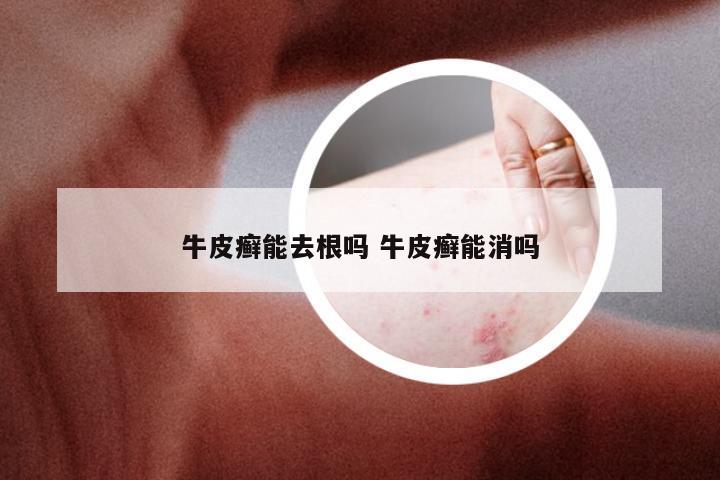 牛皮癣能去根吗 牛皮癣能消吗