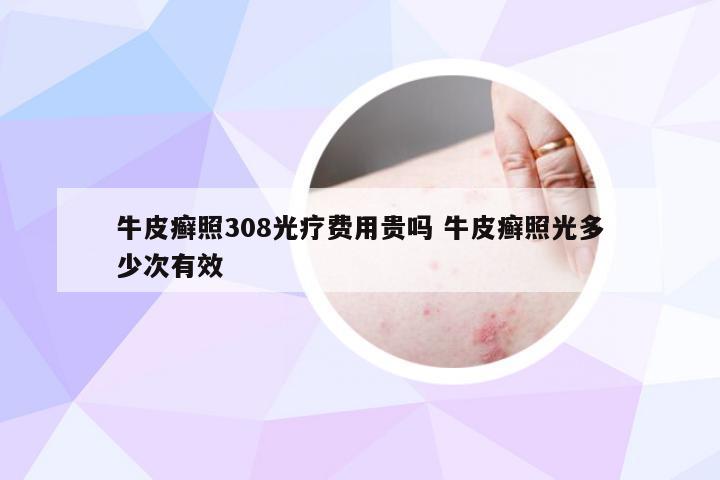 牛皮癣照308光疗费用贵吗 牛皮癣照光多少次有效