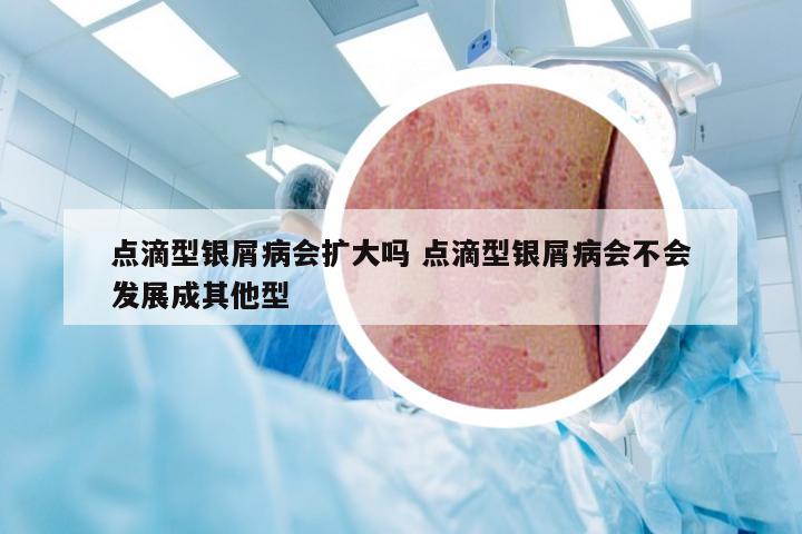 点滴型银屑病会扩大吗 点滴型银屑病会不会发展成其他型