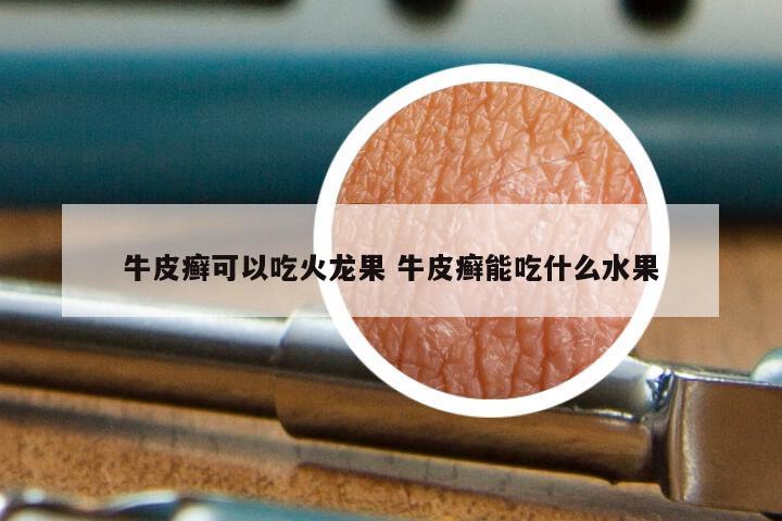 牛皮癣可以吃火龙果 牛皮癣能吃什么水果