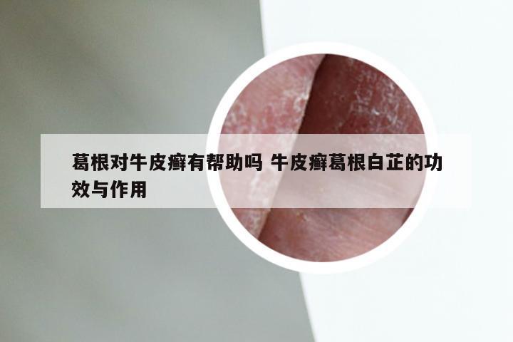 葛根对牛皮癣有帮助吗 牛皮癣葛根白芷的功效与作用