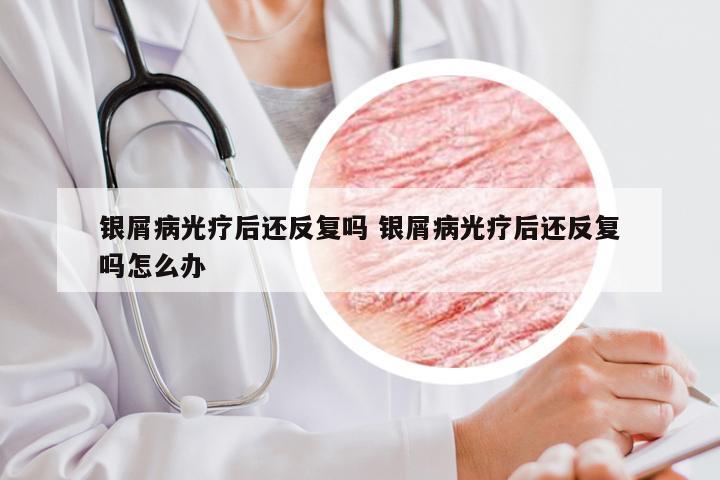 银屑病光疗后还反复吗 银屑病光疗后还反复吗怎么办