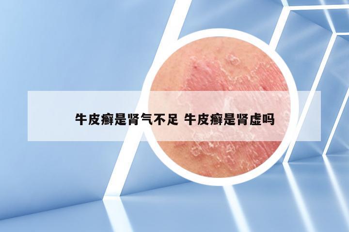 牛皮癣是肾气不足 牛皮癣是肾虚吗