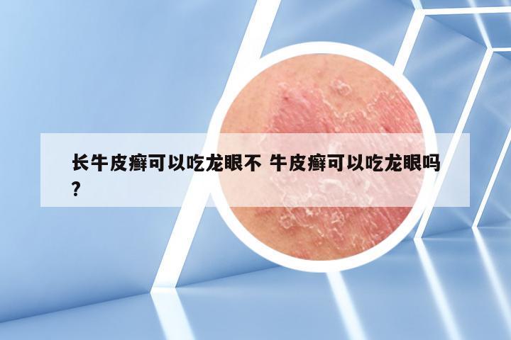 长牛皮癣可以吃龙眼不 牛皮癣可以吃龙眼吗?