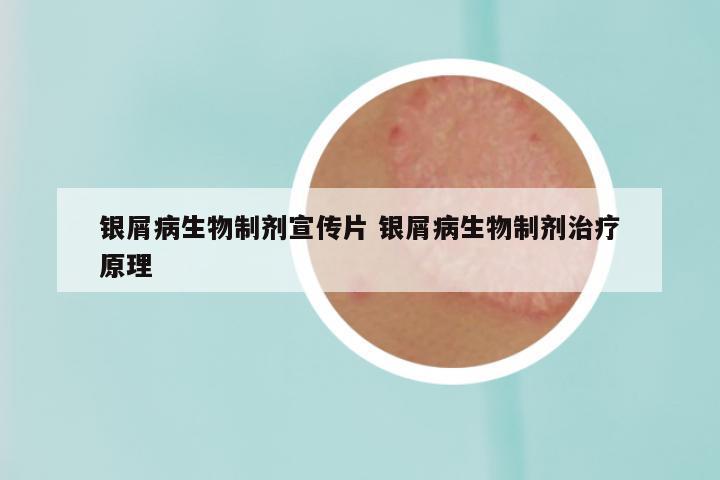 银屑病生物制剂宣传片 银屑病生物制剂治疗原理