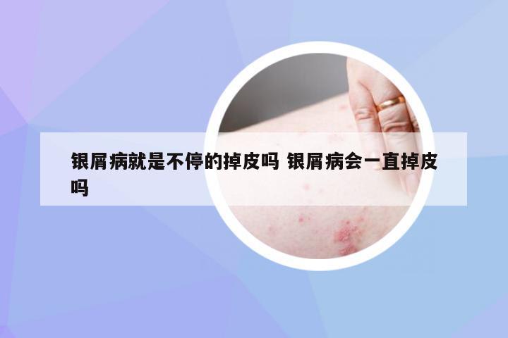 银屑病就是不停的掉皮吗 银屑病会一直掉皮吗