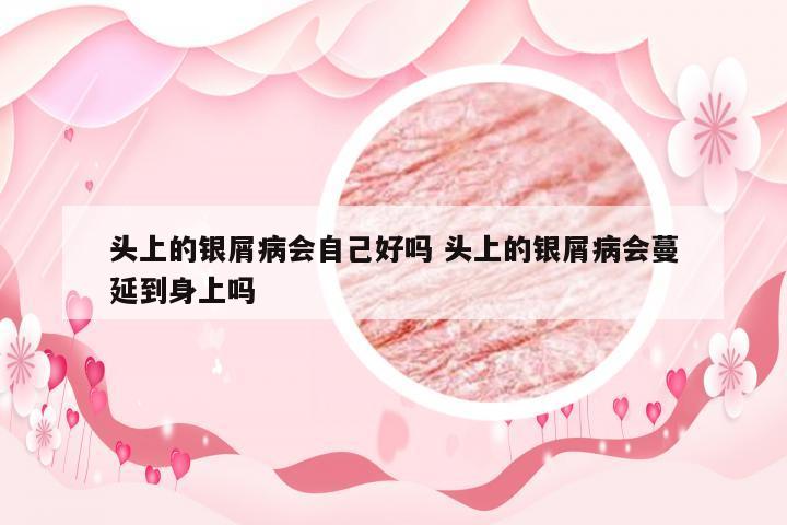 头上的银屑病会自己好吗 头上的银屑病会蔓延到身上吗