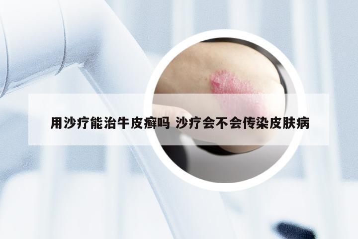 用沙疗能治牛皮癣吗 沙疗会不会传染皮肤病