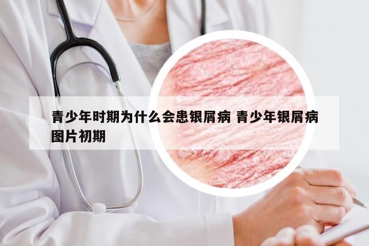 青少年时期为什么会患银屑病 青少年银屑病图片初期
