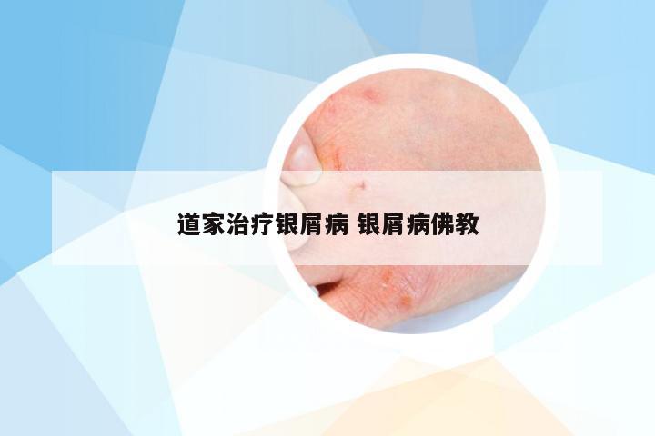 道家治疗银屑病 银屑病佛教