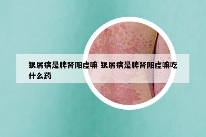 银屑病是脾肾阳虚嘛 银屑病是脾肾阳虚嘛吃什么药