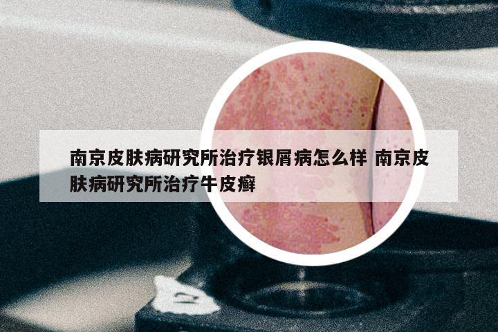南京皮肤病研究所治疗银屑病怎么样 南京皮肤病研究所治疗牛皮癣
