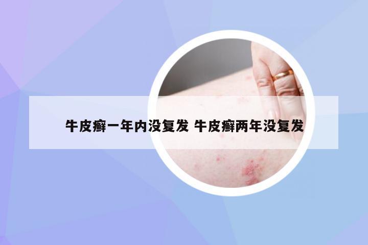 牛皮癣一年内没复发 牛皮癣两年没复发