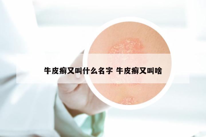 牛皮癣又叫什么名字 牛皮癣又叫啥