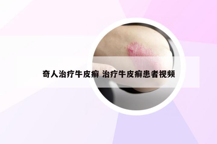 奇人治疗牛皮癣 治疗牛皮癣患者视频