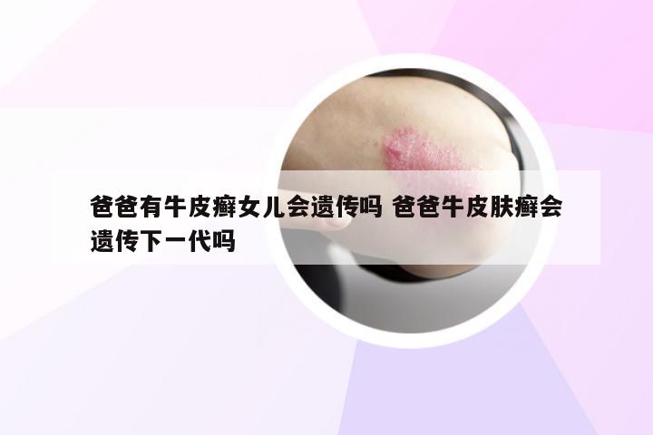 爸爸有牛皮癣女儿会遗传吗 爸爸牛皮肤癣会遗传下一代吗