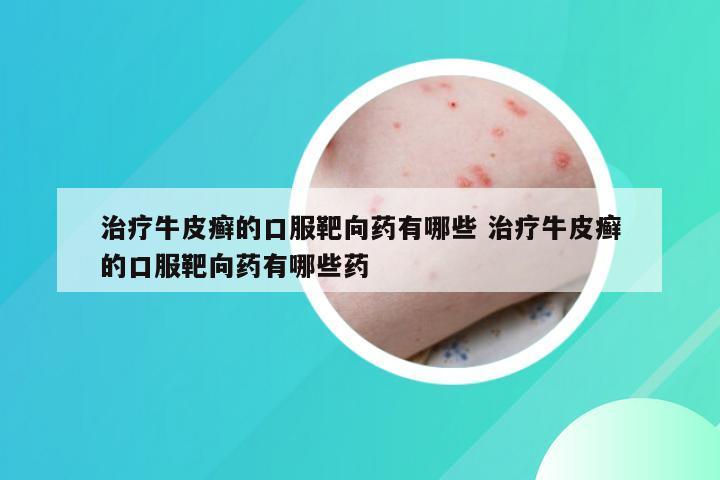 治疗牛皮癣的口服靶向药有哪些 治疗牛皮癣的口服靶向药有哪些药