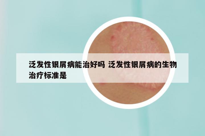泛发性银屑病能治好吗 泛发性银屑病的生物治疗标准是