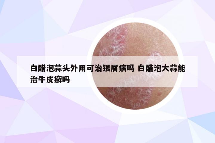 白醋泡蒜头外用可治银屑病吗 白醋泡大蒜能治牛皮癣吗