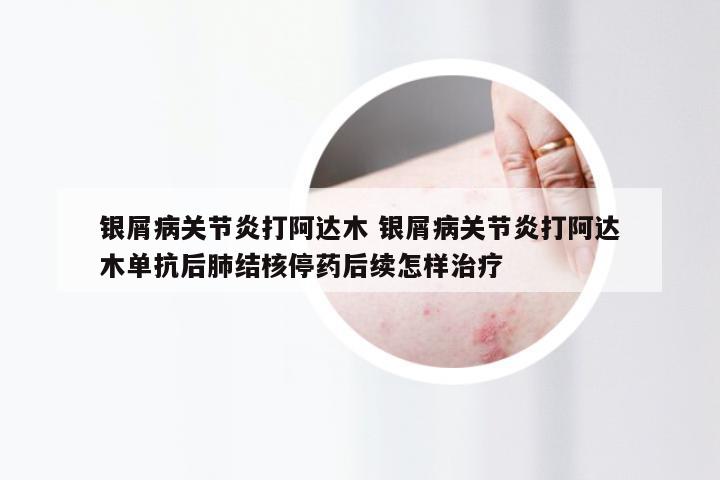 银屑病关节炎打阿达木 银屑病关节炎打阿达木单抗后肺结核停药后续怎样治疗