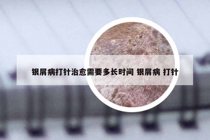 银屑病打针治愈需要多长时间 银屑病 打针