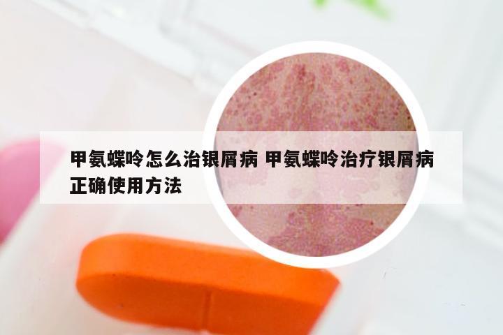 甲氨蝶呤怎么治银屑病 甲氨蝶呤治疗银屑病正确使用方法