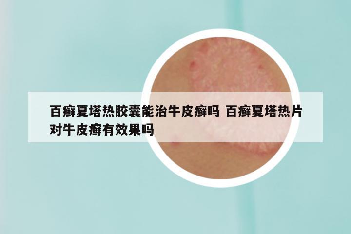 百癣夏塔热胶囊能治牛皮癣吗 百癣夏塔热片对牛皮癣有效果吗