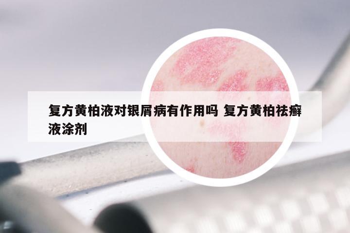 复方黄柏液对银屑病有作用吗 复方黄柏祛癣液涂剂