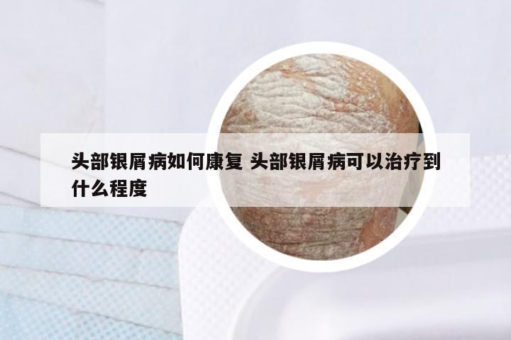 头部银屑病如何康复 头部银屑病可以治疗到什么程度