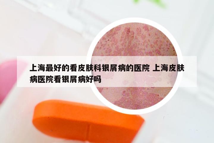 上海最好的看皮肤科银屑病的医院 上海皮肤病医院看银屑病好吗