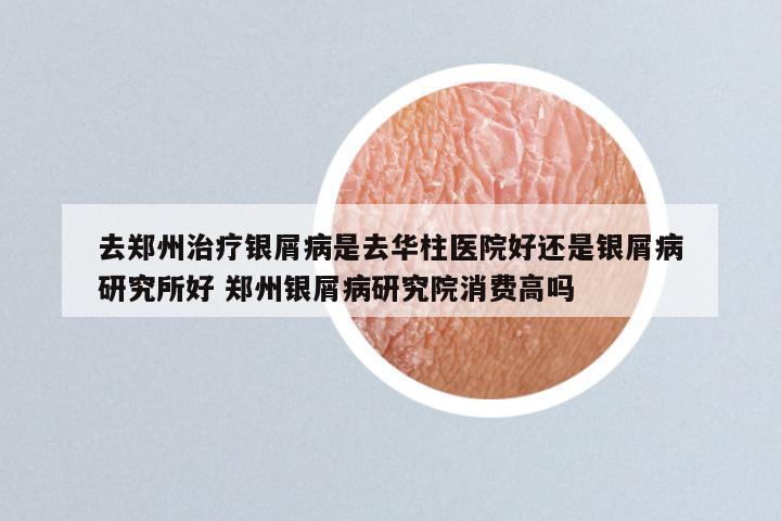 去郑州治疗银屑病是去华柱医院好还是银屑病研究所好 郑州银屑病研究院消费高吗