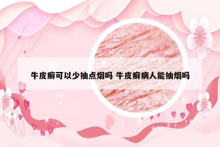 牛皮癣可以少抽点烟吗 牛皮癣病人能抽烟吗