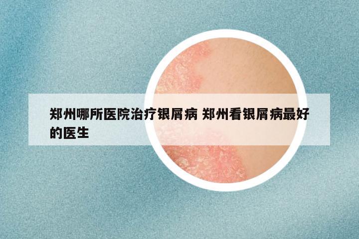 郑州哪所医院治疗银屑病 郑州看银屑病最好的医生