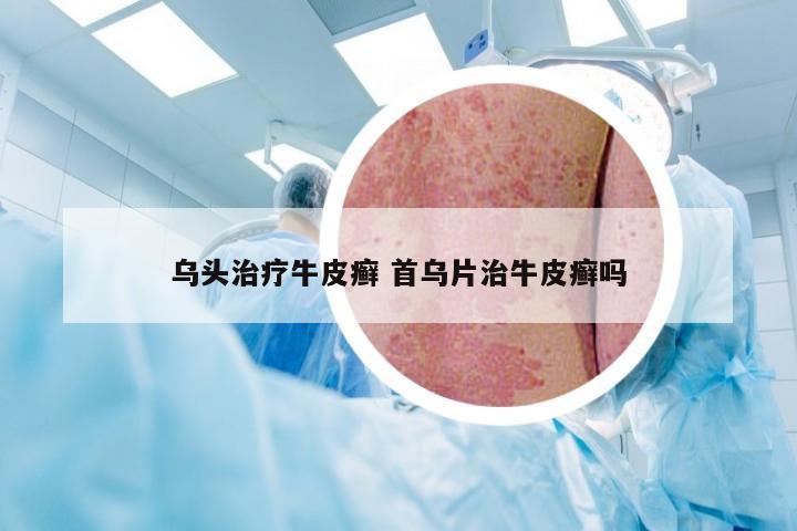 乌头治疗牛皮癣 首乌片治牛皮癣吗