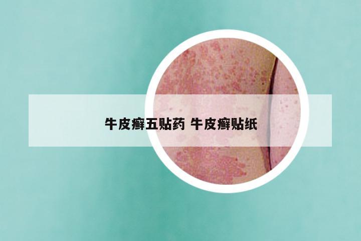 牛皮癣五贴药 牛皮癣贴纸